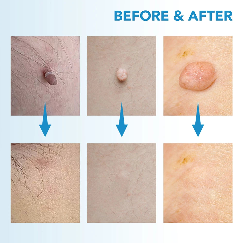 2 IN 1 Auto Micro Skin Tag Remover Device