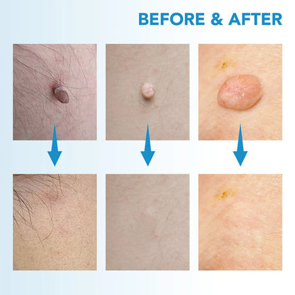 2 IN 1 Auto Micro Skin Tag Remover Device