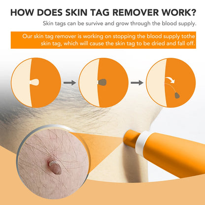 2 IN 1 Auto Micro Skin Tag Remover Device