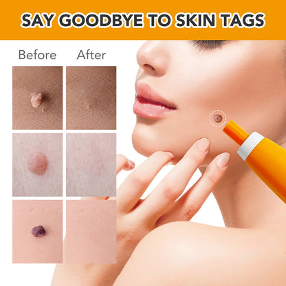 2 IN 1 Auto Micro Skin Tag Remover Device
