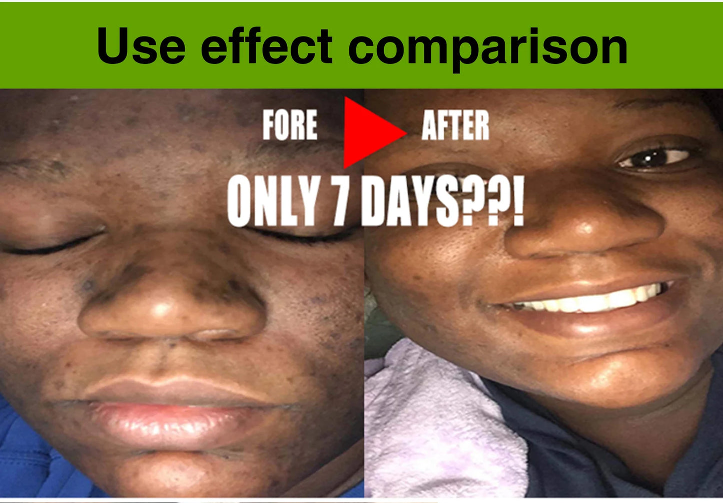 AILKE Aloe Vera Whitening Soap, Remove Acne